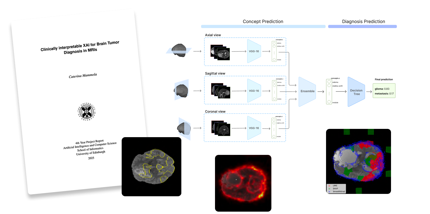 XAI model for Brain Tumor MRI Diagnosis